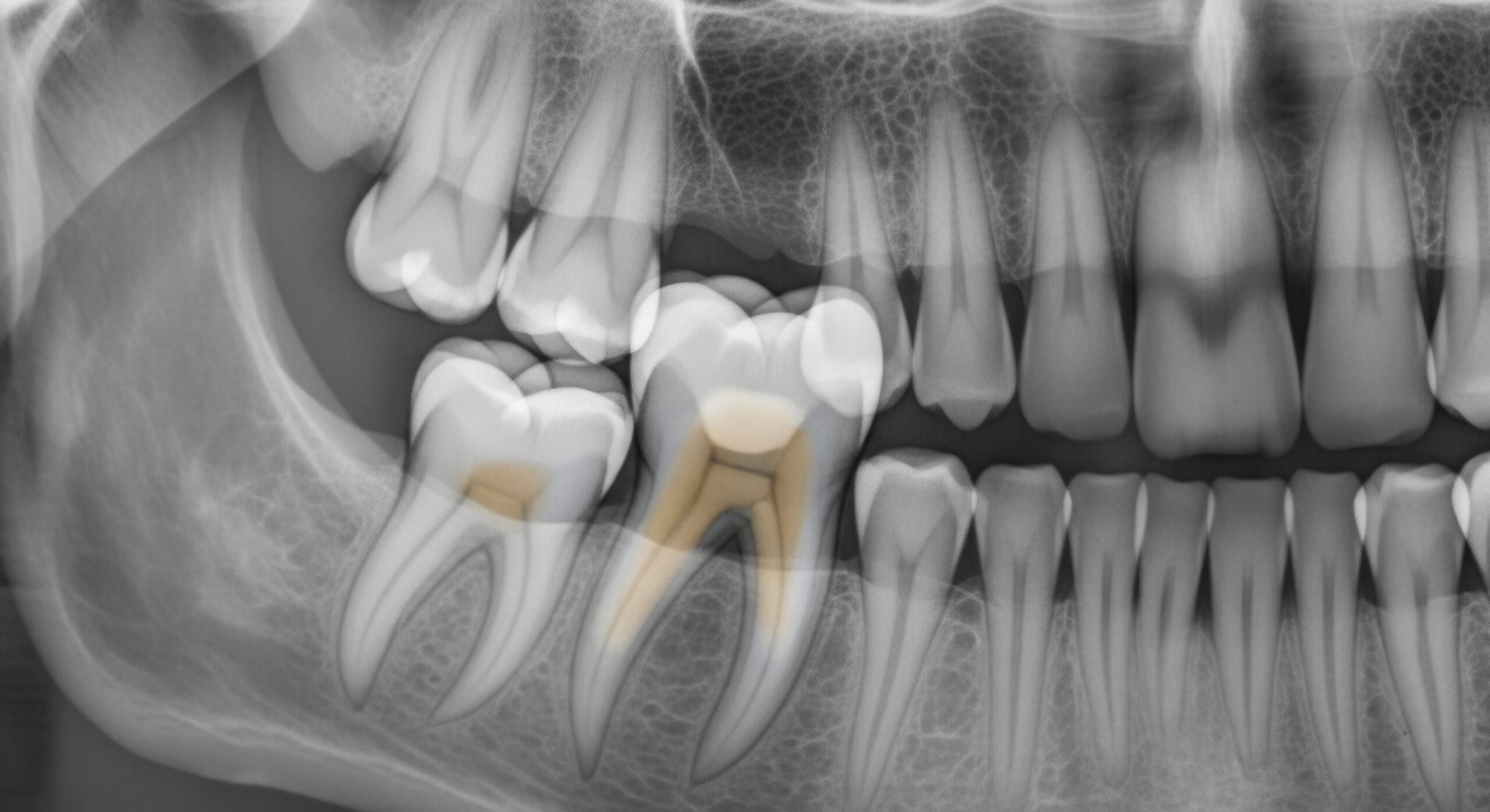 Understanding Impacted Wisdom Teeth and Their Potential Dental Health Complications