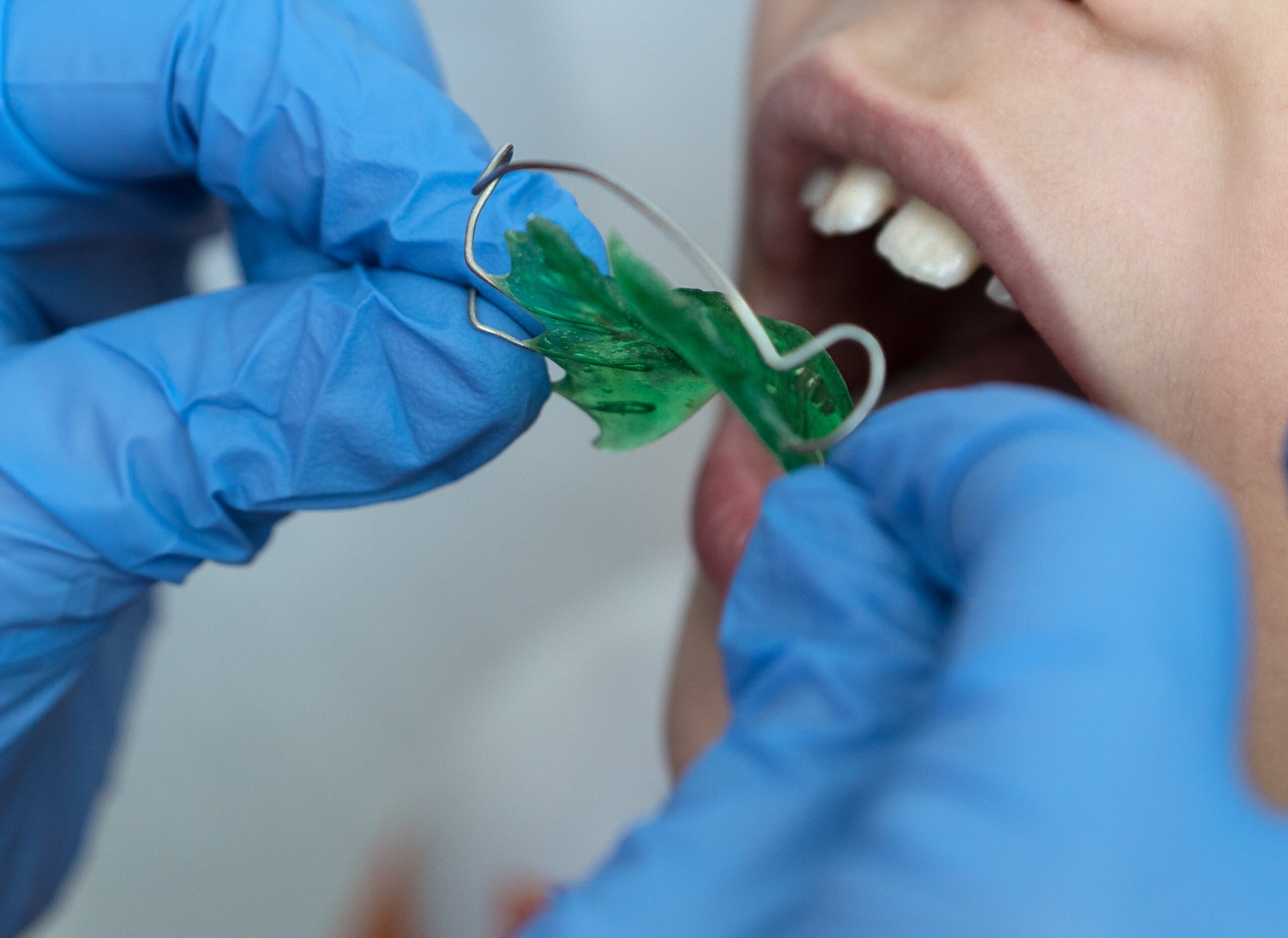dentist's hands in medical gloves put green children's orthodontic plaques on the child’s teeth, orthodontic bite correction, healthcare concept