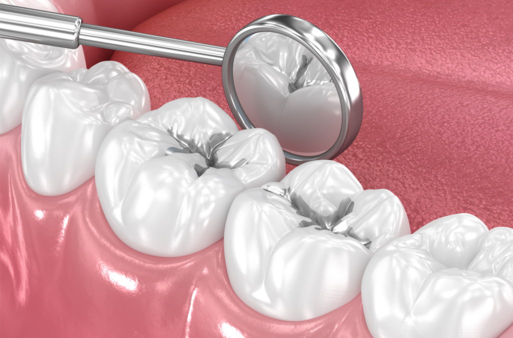 Amalgam Removal