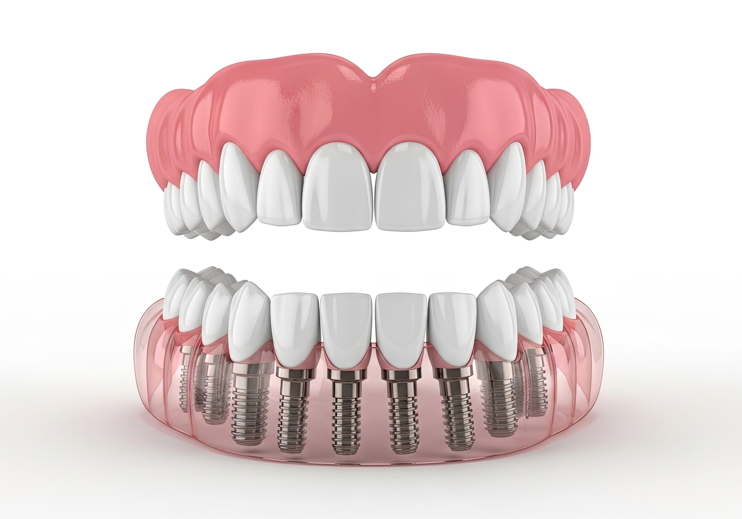 Complete Dental Prosthesis Model on White Background, Showing Implants and Gum Structures
