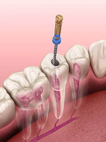 root-canal-treatment